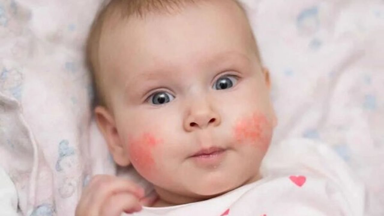 Bebeklerde Süt Alerjisi: Tanı, belirtiler ve yönetim yolları