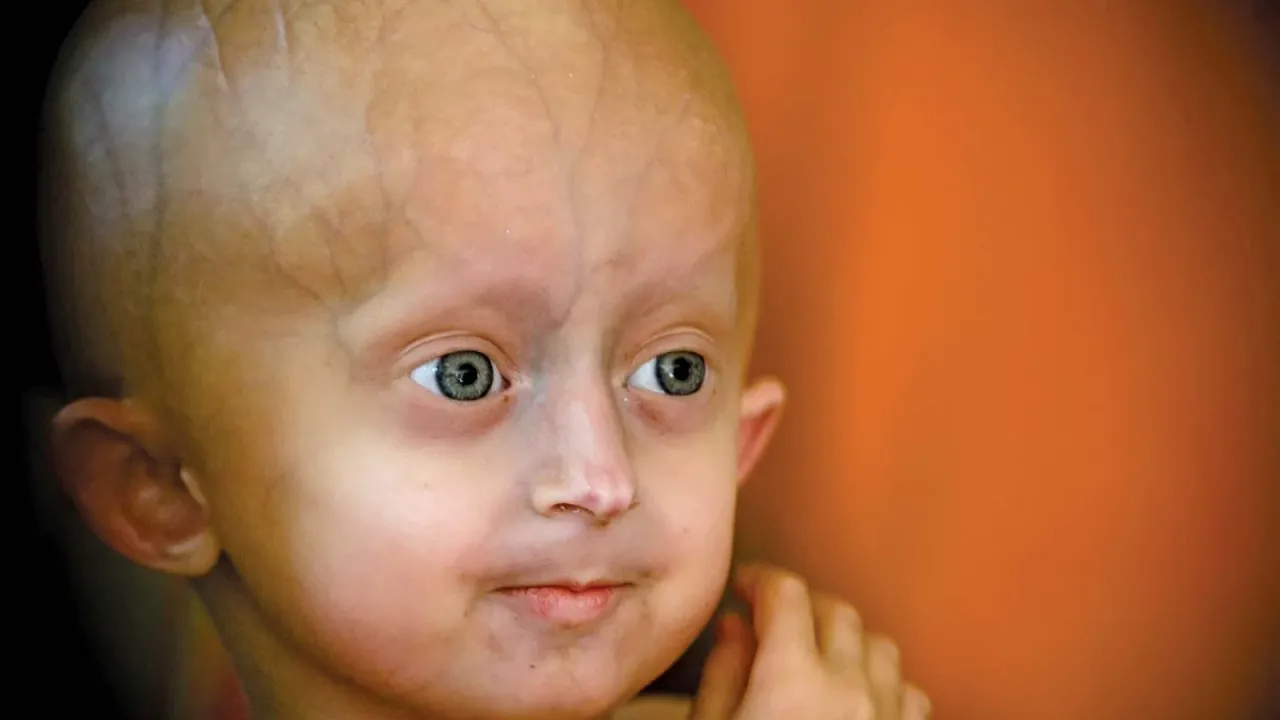 Nadir görülen erken yaşlanma hastalığı: Progeria nedir?