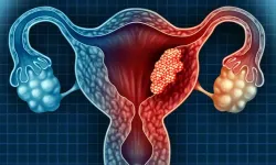 Endometrial kanser: Kadınların karşılaştığı önemli bir sağlık tehlikesi