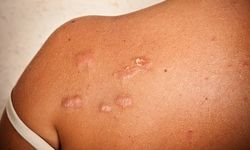 Keloid: Ciltteki anormal iyileşme ve oluşma