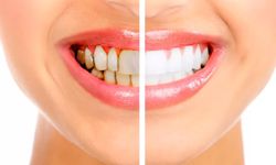 Sağlıklı gülüşlerin sırrı: Diş taşı temizliği