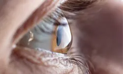 Astigmatizma: Genetik etki ve göz sağlığı üzerindeki rolü