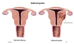 Adenomyosis nedir? Belirtileri nelerdir?