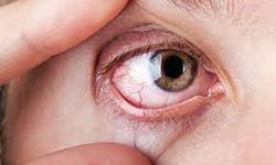 Glokom: Göz sağlığını tehdit eden görme kaybı