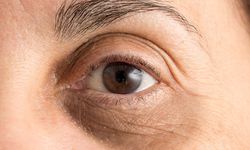 Göz altı morluklarının tedavisi ve yöntemleri