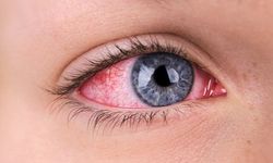 Kırmızı göz hastalığı: Belirtiler, tedaviler ve önlemler