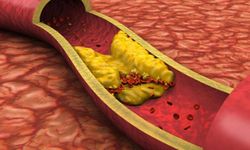 Kolesterol: Sağlık için önemli bir belirleyici ve risk faktörü