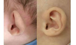 Bebeklerde kulaktaki şekil bozukluğunu ameliyatsız yöntemle gidermek mümkün