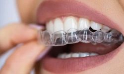 Diş teline avantajlı alternatif: Şeffaf plaklar