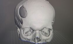 3D yazıcı ile kemik çimentosu kullanılarak kafatası ameliyatı yapıldı