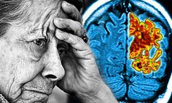 Alzheimer'ın sessiz katili: Beyindeki gizli iltihaplanma ortaya çıktı!