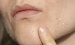 Sadece ergenlikte değil, her yaşta görülüyor: Uzmanlar uyardı: İşte doğru tedavi yöntemi