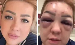 Estetik merkezinden hastaneye! Yüzü tanınmaz hale geldi