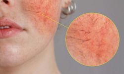Rosacea sadece cilt değil, ruh sağlığını da etkiliyor