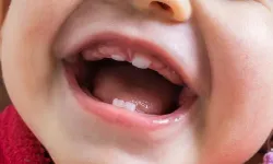 Uzmanlar bebeği olanlara uyarı! Dişleri çürük görünüyorsa dikkat