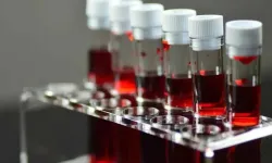 AB Kan Grubuna sahip olanlar bu kan grubu alzheimer riskini %82 artırıyor! Uzmanlar uyarıyor!