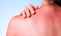 Yaz aylarında güneş yanıklarına dikkat: Uzmanından korunma önerileri