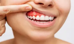 Ağız içinde geçmeyen yara varsa dikkat! Diş çürükleri ağrıya ve diş kaybına yol açabilir
