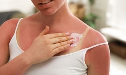 Güneş yanığı sonrası ne yapılmalı? İşte doğru müdahale