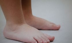 Her vakada panik yapmayın! Çocuklarda sık görülüyor: Düztabanlık ne zaman normal, ne zaman riskli?