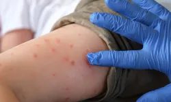 Sivrisinek ısırığıyla bulaşıyor! Chikungunya virüsü hangi belirtileri gösteriyor?