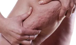 Bacaklarda geçmeyen ağrı ve şişliklere dikkat! Lipödem tedavisinde yeni dönem başladı