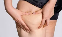 Diyet yapıyor ama bacaklarınız incelmiyorsa dikkat! Uzmanı lipödem için uyardı