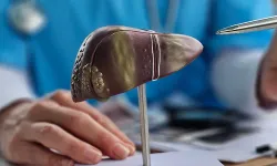 Sirozun ilk belirtilerine dikkat! Sirozdan korunmanın yolları neler? Uzmanı özellikle bu şikayetleri sıraladı