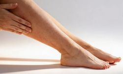 “Çilek bacak” şikayeti olanlar dikkat! Uzmanlar uyarıyor: Cildinize zarar verebilirsiniz