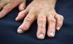 Romatoid artrit en çok elleri vuruyor! Uzmandan erken teşhis uyarısı