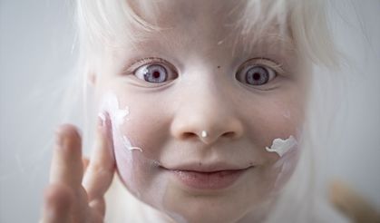 4 yaşındaki Defne’nin hikayesi! 13 Haziran’da Albino hakları ve bilinçlenme günü