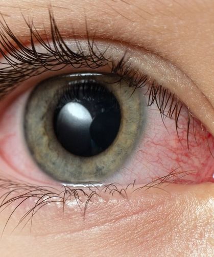 Gözde basit kızarıklık diye geçmeyin! Uzmanı uyardı: Görme kaybına kadar ilerleyebiliyor