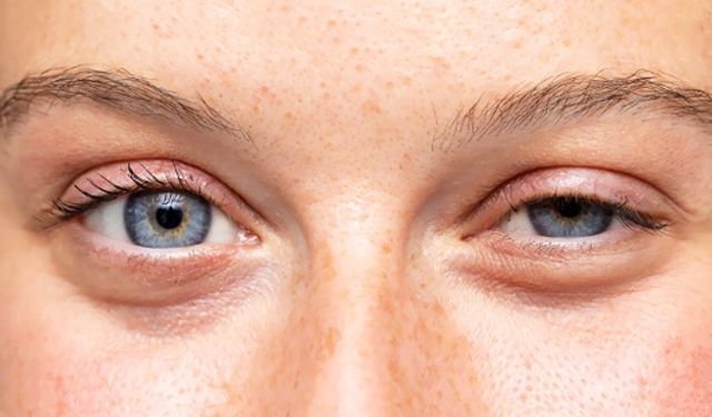 Göz kapağı düşüklüğü: Estetik ve sağlık sorunlarına yeni çözümler