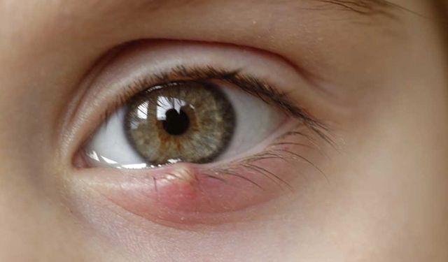 Göz sağlığı tehlikesi: Arpacıklar gözleri tehdit ediyor