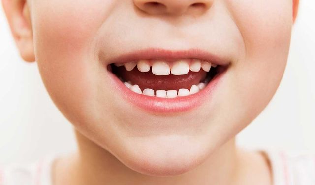 Çocuklarda diş çürümesi: Sağlıksız alışkanlıkların ve yetersiz bakımın sonucu