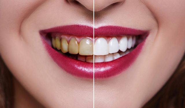 Diş Beyazlatma: Sağlık ve estetik için önemli adımlar