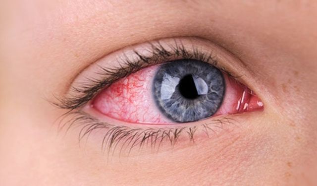 Kırmızı göz hastalığı: Belirtiler, tedaviler ve önlemler