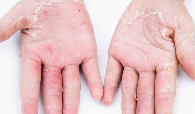 Uzmanlar uyarıyor: Deterjan kullanımı ellere zarar verebilir!