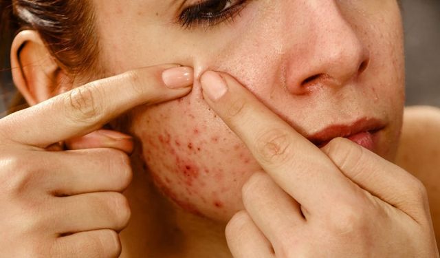 Göz altınızda sivilceler mi çıkmaya başladı! Nedeni bu alışkanlıklar olabilir: İşte kurtulmanın doğal yolları