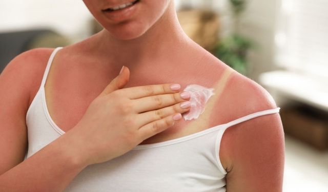 Güneş yanığı sonrası ne yapılmalı? İşte doğru müdahale