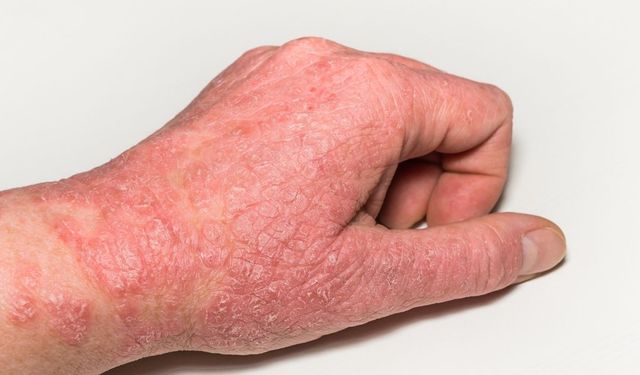 Sonbahar geldi, eller alarm veriyor! Çatlamadan ve kanamadan önce bunları yapın
