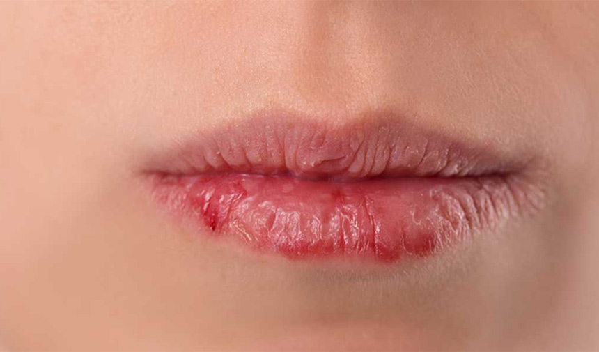 Самые обветренные губы. Лучшие средства для обветренных губ. Обветрились губы что делать в домашних условиях. Сильно обветренные губы