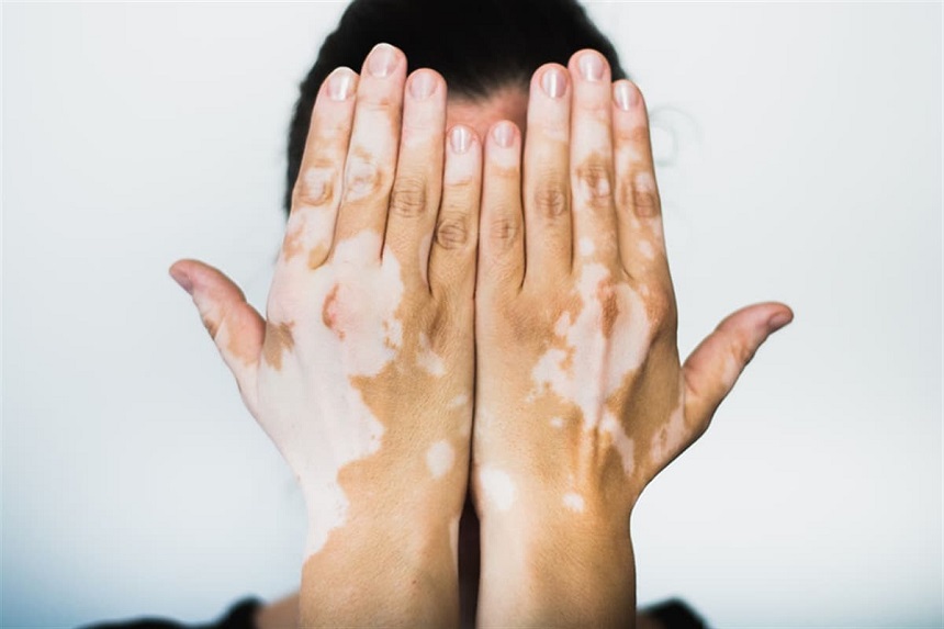 Vitiligo (1)