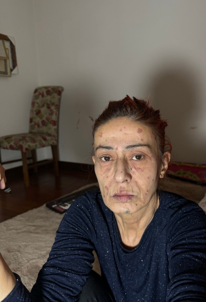 Sac Boyasi Nedeniyle Yuzu Yanan Yildiz Tilbe Saglik Durumu Hakkinda Bilgi Verdi 8 My6 X