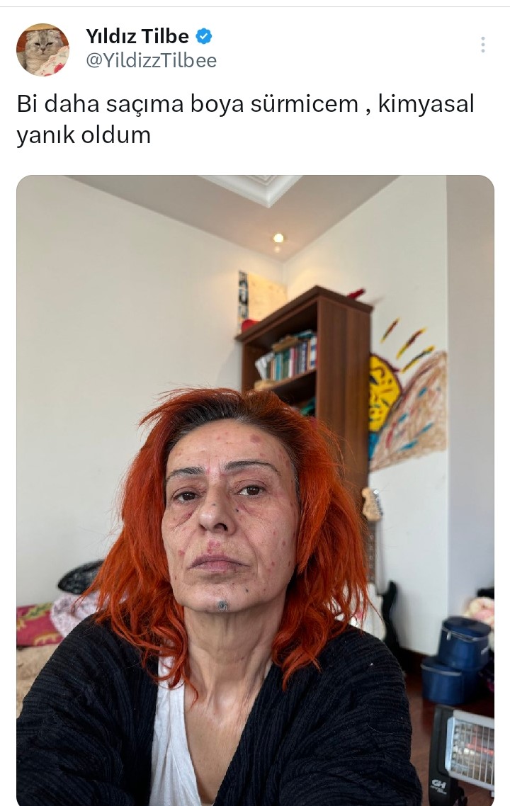 Sac Boyasi Nedeniyle Yuzu Yanan Yildiz Tilbe Saglik Durumu Hakkinda Bilgi Verdi T H De Q