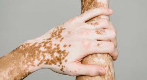 Vitiligo2