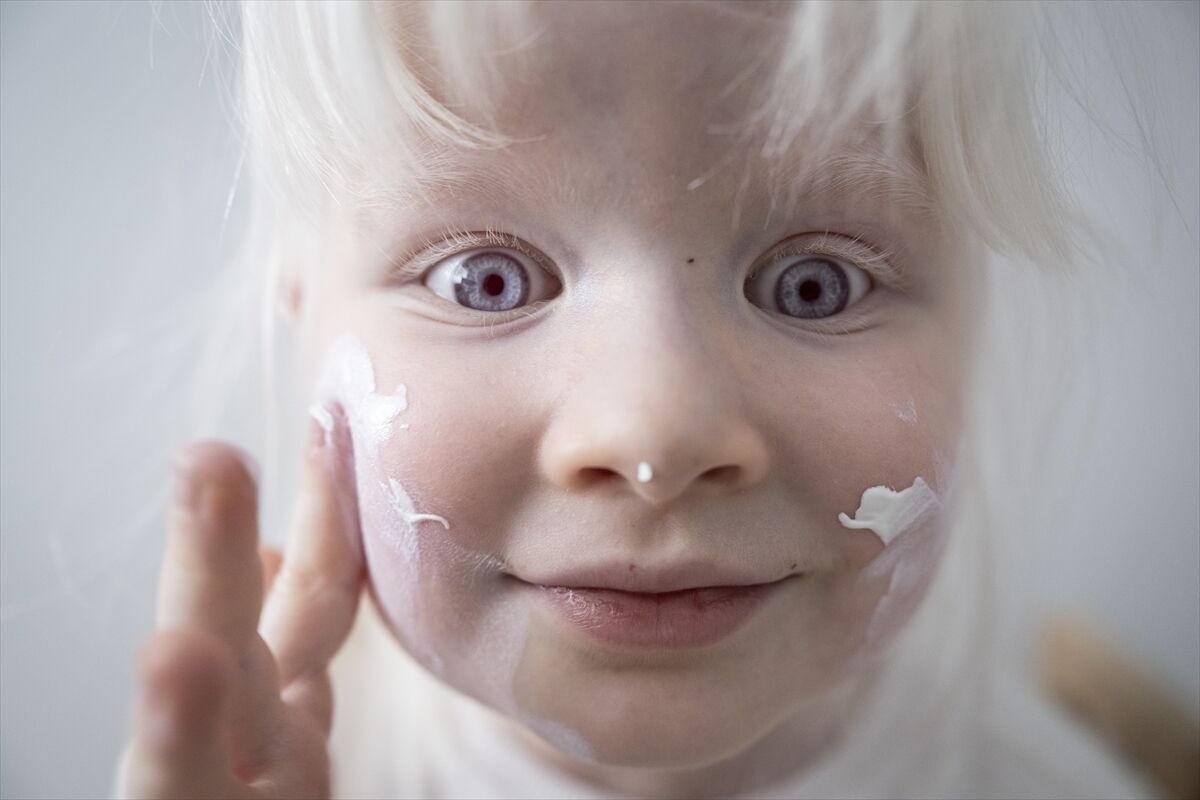 4 yaşındaki Defne’nin hikayesi! 13 Haziran’da Albino hakları ve bilinçlenme günü
