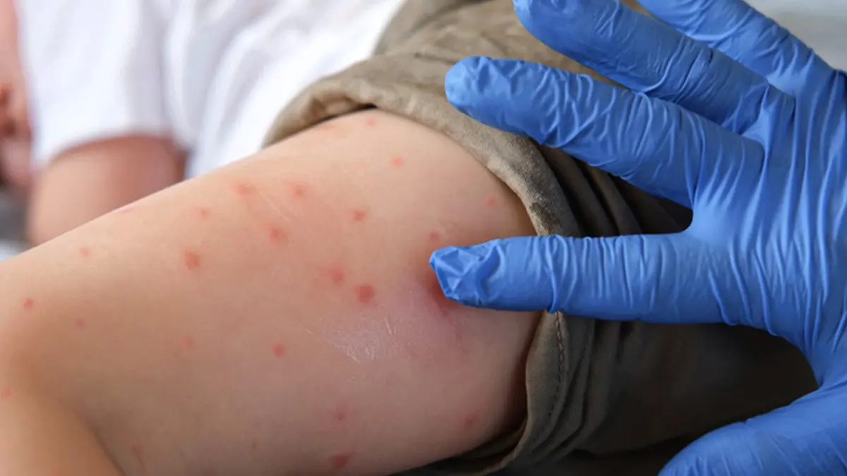 Sivrisinek Isirigiyla Bulasiyor Chikungunya Virusu Hangi Belirtileri Gosteriyor