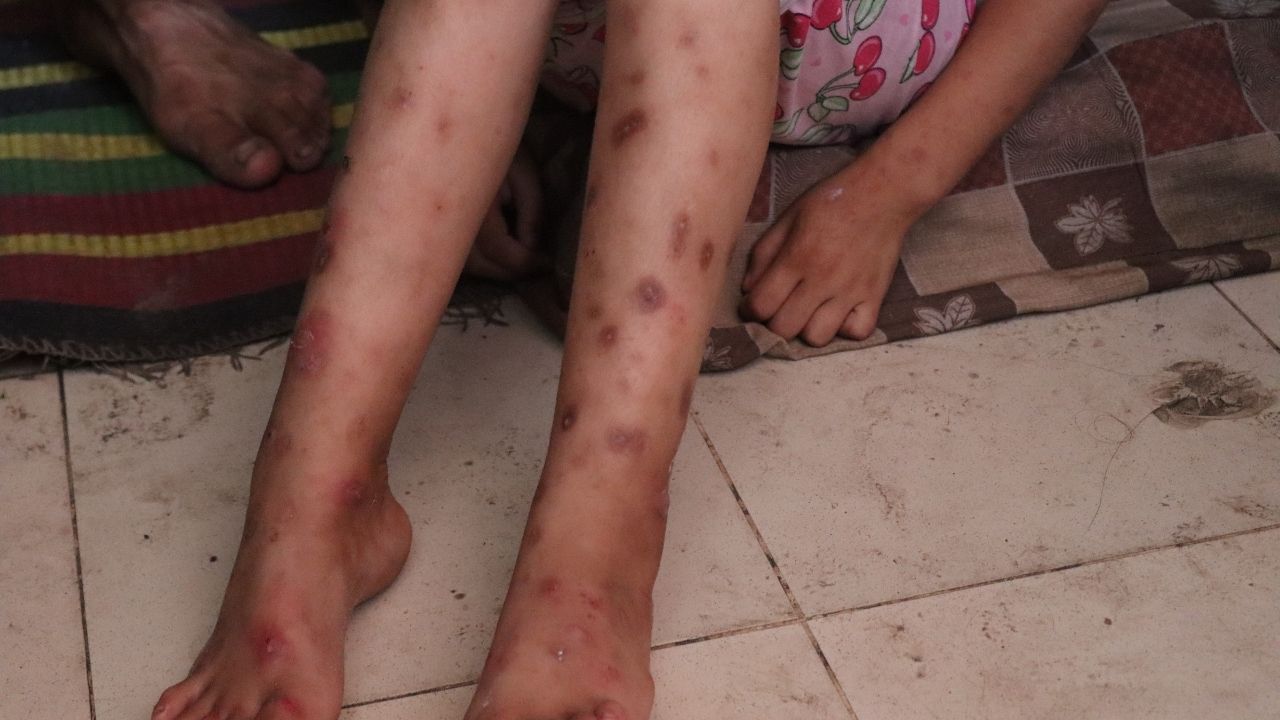 Suçiçeği Alarmı! İki Haftada 9 Binden Fazla Vaka Tespit Edildi (2)